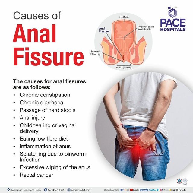 Anal Fissure Symptoms Causes Types Complications Off